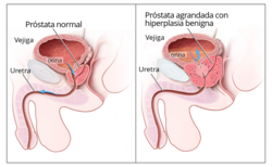 Próstata normal y agrandada por hiperplasia benigna de próstata