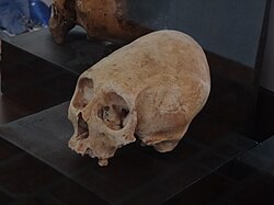 Cráneo de individuo con deformación craneal oblicua
