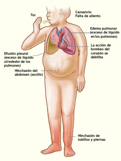 Ilustración que muestra los principales signos y síntomas de la insuficiencia cardíaca