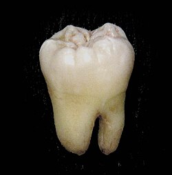 Vista clínica de un cordal inferior retenido en la arcada dental.
