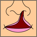 Representación gráfica de una fisura labial unilateral completa