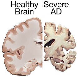 Comparación visual entre un cerebro sano y uno afectado por la enfermedad de Alzheimer grave.
