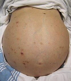Persona que presenta distensión abdominal severa por ascitis derivada de hipertensión portal