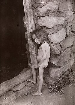 Niña rusa con signos de desnutrición en 1921