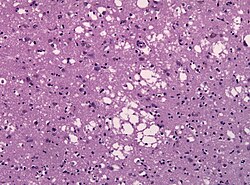 Micrografía que muestra espongiosis a nivel del lóbulo temporal en un paciente con ECJ