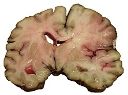Sección cerebral post mortem tras un ictus a nivel de la arteria cerebral media