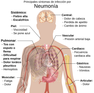 Ilustración de los síntomas principales de la neumonía infecciosa