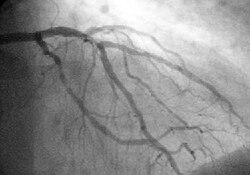 Arteriografía coronaria mostrando el flujo y la apertura de las arterias del corazón
