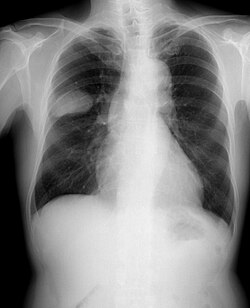 Cáncer de pulmón lado derecho