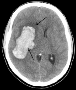 Imagen médica que muestra sangrado intracerebral con edema circundante