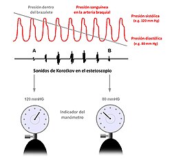 Gráfico de sonidos de Korotkoff