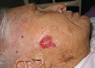 Representación de un carcinoma basocelular en la piel