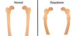 Radiografía o ilustración médica que muestra la deformidad y arqueamiento de los fémures por déficit de vitamina D.