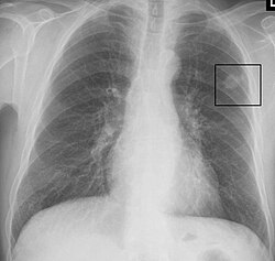 Radiografía de tórax con tumor pulmonar