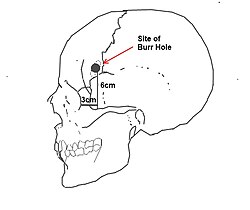 Punto de incisión normalizado para lobotomía pre-frontal