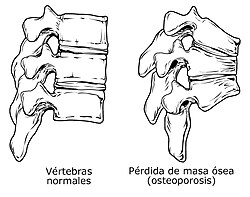 Osteoporosis