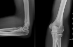 Radiografía de un codo humano