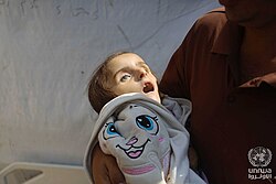 Fotografía relacionada con la crisis alimentaria y la desnutrición infantil en Gaza