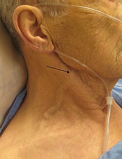 Un hombre con insuficiencia cardíaca y marcada distensión venosa yugular