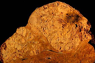 Espécimen de necropsia que muestra un hepatocarcinoma desarrollado sobre tejido cirrótico