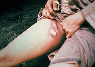 Ejemplo de bubón en el muslo de un paciente infectado
