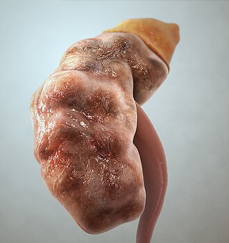 Ilustración detallada de un riñón afectado por insuficiencia renal