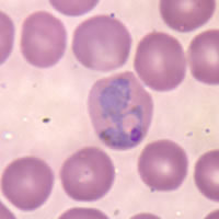 Glóbulo rojo infectado por Plasmodium vivax