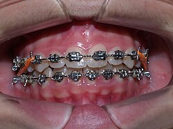 Vista clínica de aparatología fija con brackets gemelares en ambas arcadas