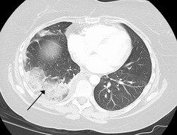 Infarto del pulmón debido a embolia pulmonar