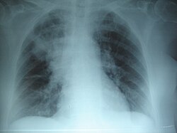 Radiografía focalizada en una neumonía apical derecha