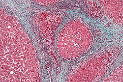Micrografía de tejido hepático con tinción tricrómica que revela fibrosis avanzada