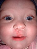 Niña un mes después de la cirugía