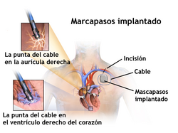 Esquema ilustrativo de un marcapasos implantado en la zona torácica