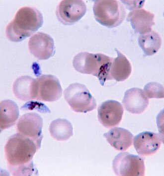 Trofozoítos y gametocitos de Plasmodium falciparum en sangre humana