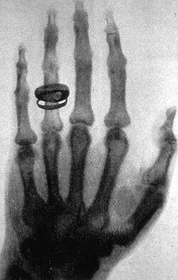 Radiografía histórica de la mano de una mujer tomada por Wilhelm Röntgen en 1896