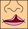 Representación gráfica de una fisura labial unilateral incompleta