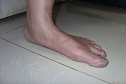 Pie plano en un adulto