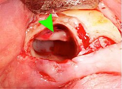 Alveolo dental posterior a la extracción de un cordal inferior con indicación del nervio alveolar inferior.