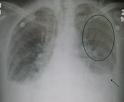 Edema pulmonar agudo y cardiomegalia en radiografía de tórax
