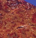 Hepatopatía congestiva