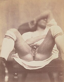 Fotografía médica antigua de una persona con genitales ambiguos.
