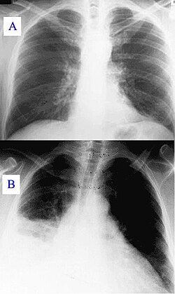 Comparativa anatómica entre pulmón sano y pulmón con derrame pleural
