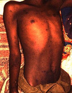 Enfermo de tifus en Burundi