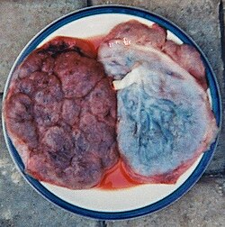 Vista anatómica de la placenta humana por ambas caras