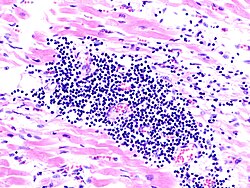 Imagen histopatológica de una miocarditis viral en un paciente fallecido por insuficiencia cardíaca aguda