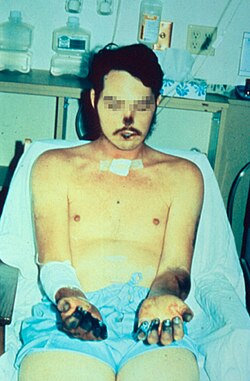 Necrosis acral y equimosis en un paciente en recuperación