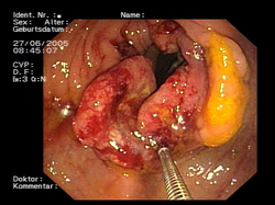 Imagen endoscópica de un cáncer colorrectal