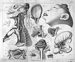 Ilustración de teratología de Étienne Geoffroy Saint-Hilaire en Philosophie Anatomique