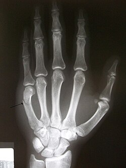 Fractura de metacarpo