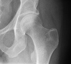 Radiografía de una cadera humana normal mostrando la cabeza del fémur y la cavidad cotiloidea.